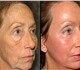 Скачать бесплатно foto Салоны красоты Крем Instantly Ageless - органический аналог ботокса, Как убрать морщины за 2-3 минуты, 3987773 в Москве Foto в Красота и здоровье Салоны красоты Безинвазивный способ убрать морщины, отеки в Москве 3 600